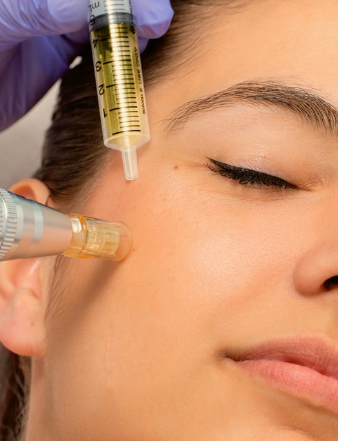 Exosomas con Dermapen | Laura Ferrández